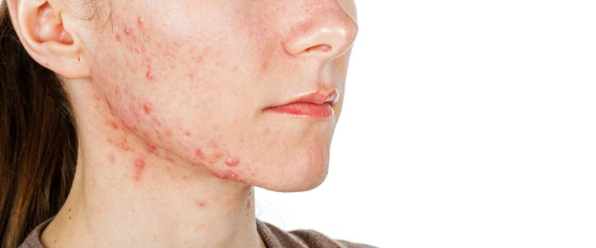 How to treat acne